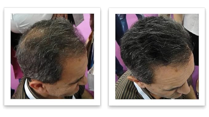 Caboki Hair Loss Concealer. All-Natural Hair Building Fiber. Make Thin Hair Look 10X Fuller Instantly. Eliminate the Appearance of Bald Spot and Thinning Hair (30G, 90-Day Supply). Salt & Pepper-Dark