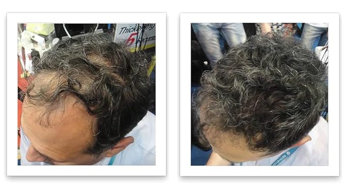 Caboki Hair Loss Concealer. All-Natural Hair Building Fiber. Make Thin Hair Look 10X Fuller Instantly. Eliminate the Appearance of Bald Spot and Thinning Hair (30G, 90-Day Supply). Salt & Pepper-Dark