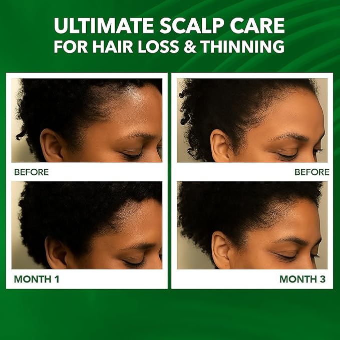 Scalp Oil for Hair Loss & Thinning Hair: Stimulates Follicles and Nourishes Scalp with Batana, Rosemary & Tea Tree – Ideal for Coily, Curly, Dry & Damaged Hair – Soothes Dry, Itchy, Flaky Scalp (60mL)