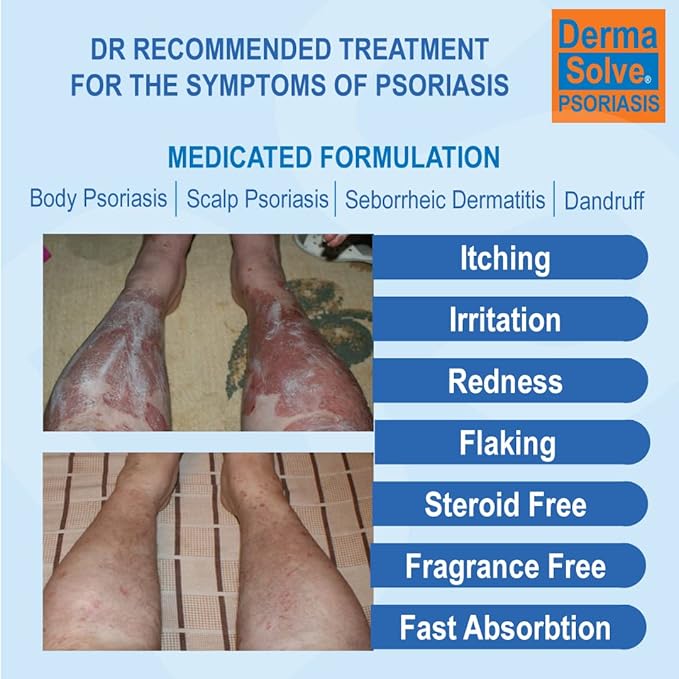 Dermasolve Psoriasis, Seborrheic Dermatitis and Dandruff Cream Formulated to Treat Itchy Skin & Prevent Future Flares to Provide Soothing Moisturizing Relief. (4.0 oz.) 5-Pack