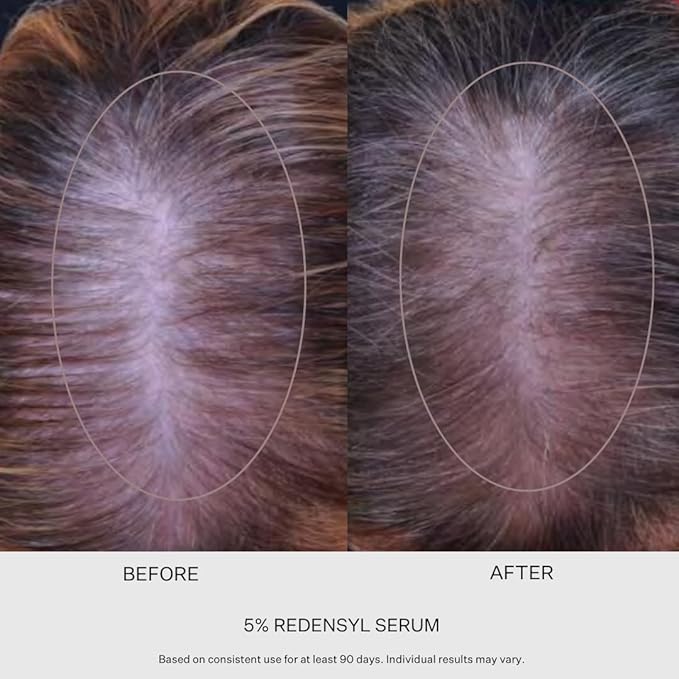 5% Redensyl Hair Growth Serum - Vegan Follicle Activator & Hair Thickening Serum for Men & Women's Hair Growth. Scalp & Hair Density Serum for Thicker, Fuller Hair Care