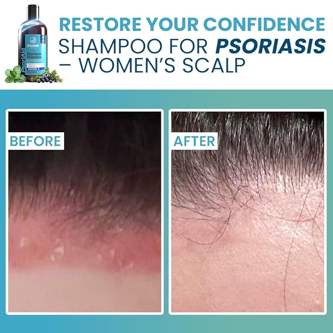NEW 2025 Psoriasis Shampoo with Salicylic Acid | 13.5 fl. oz | New Formula with Peat and Menthol for itchy, flaky and red scalp.