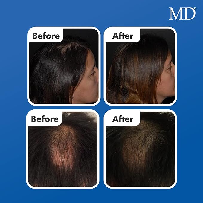 MD Follicle Energizer | Natural Hair Growth Serum | Biotin Infused to Block DHT Production and Prevents Hair Loss | 1 Fl Oz 60-Days Supply