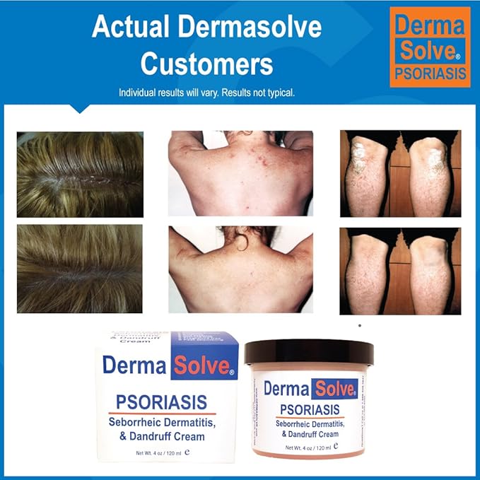 Dermasolve Psoriasis, Seborrheic Dermatitis and Dandruff Cream Formulated to Treat Itchy Skin & Prevent Future Flares to Provide Soothing Moisturizing Relief. (4.0 oz.) 3-Pack