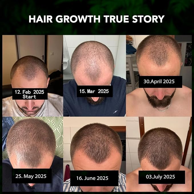 Minoxidil 5% for Men and Women Hair Growth Serum, Minoxidil Topical Solution Spray Treatment for Hair Loss, Thinning, Hair Regrowth & Thicker, Grow Hair Spray 2.02 fl.oz