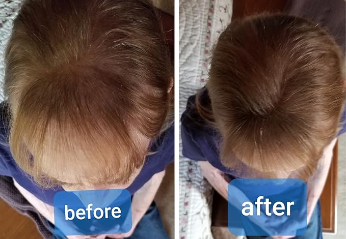 Caboki All-Natural Hair Building Fiber. Make Thin Hair Look 10X Fuller Instantly. Eliminate the Appearance of Bald Spot and Thinning Hair (30G, 90-Day Supply). Medium Brown
