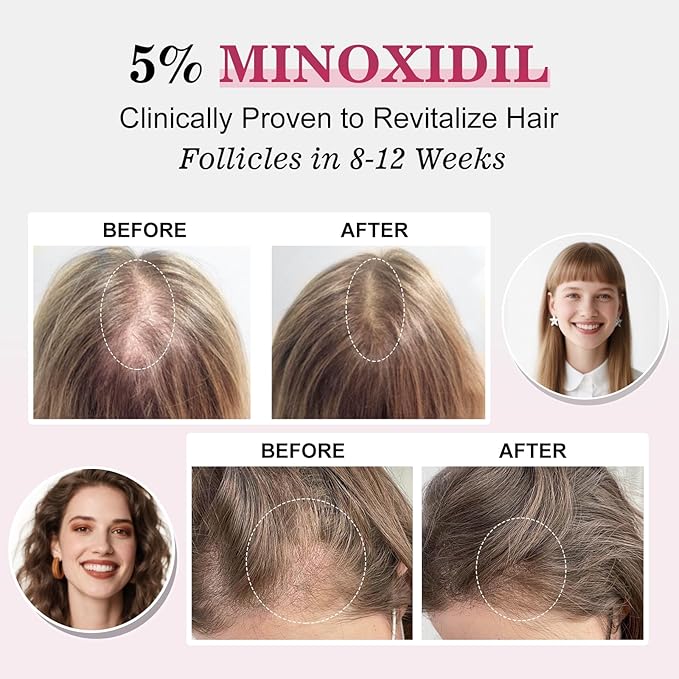 5% Minoxidil for Women Hair Regrowth Spray, hers hair regrowth treatment Infused with Biotin, Extra Strength Treatment to Combat Hair Loss and Thinning, 6 Bottles(100 Ml)