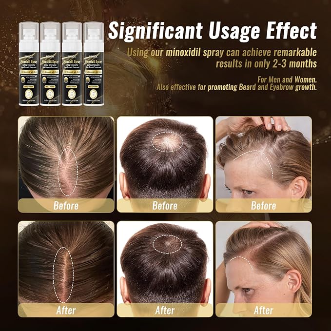5% Minoxidil Spray for Men & Women (4 Month Supply)-Extra Strength Hair Growth Spray with Biotin & Castor Oil,Clinically Proven for Thinning Hair & Beard Regrowth, Non-Greasy Formula 4 pack(8.12 oz)