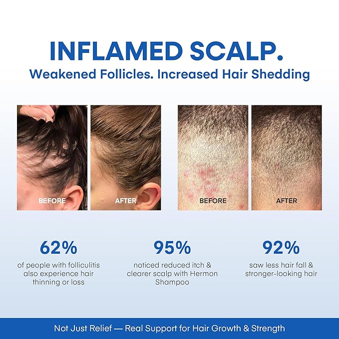 Hermon Folliculitis Shampoo for Itchy Scalp: Psoriasis, Dandruff & Seborrheic Dermatitis & Biotin – Soothes | Exfoliates | Reactivates Follicles