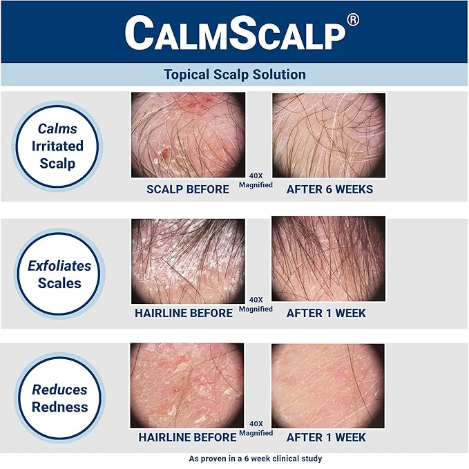 Scalp Serum | Scalp Itch Relief | Scalp Treatment | Exfoliates Scales and Flakes | Clinically Proven | Made in USA | 4 oz