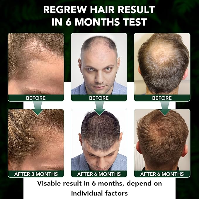 Minoxidil 5% for Men and Women Hair Growth Serum, Minoxidil Topical Solution Spray Treatment for Hair Loss, Thinning, Hair Regrowth & Thicker, Grow Hair Spray 2.02 fl.oz