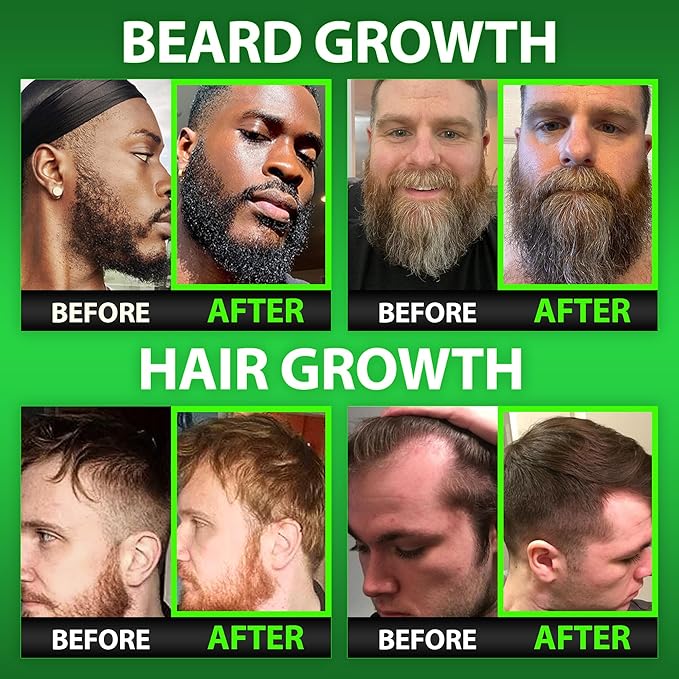 Beard Growth Kit w/GROW Beard Oil for Men (Mens Beard Growth Serum) + Biotin Gummies Beard Growth Vitamins & Hair Growth Vitamins for Men