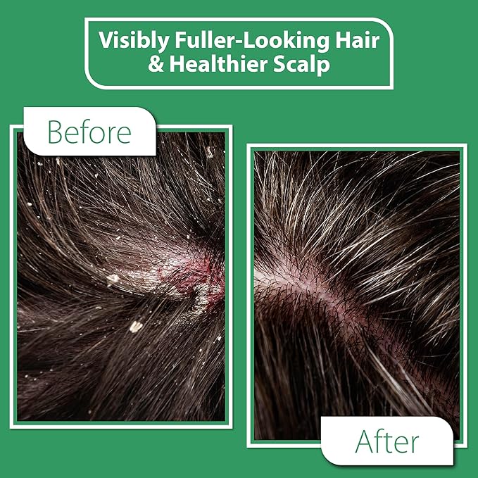 Scalp Serum with Charcoal + Tea Tree - Non GMO Scalp Moisturizer for Dry Itchy Scalp Relief - Fragrance Free Serum with Tea Tree Oil for Scalp Treatment - Rejuvenating Hair Serum with Vitamin