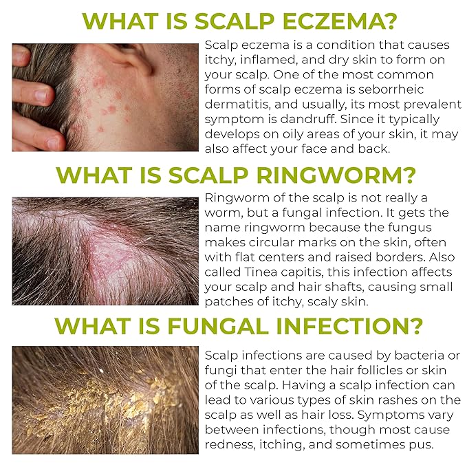 Folliculitis Shampoo | Antifungal Shampoo for Seborrheic Dermatitis, Scalp Psoriasis & Dandruff | Soothes Itchy, Dry Scalp | Cleanses, Exfoliates & Removes Build-Up | Reactivates Hair Follicles