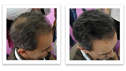 Caboki Hair Loss Concealer. All-Natural Hair Building Fiber. Make Thin Hair Look 10X Fuller Instantly. Eliminate the Appearance of Bald Spot and Thinning Hair (30G, 90-Day Supply). Salt & Pepper-Dark