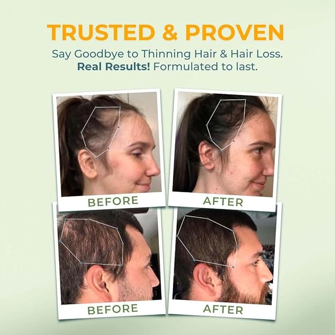 Vital Hair Complex -Hair Growth Vitamins for Women and Men -Biotin & Vitamin B -Hair Growth Supplement for Healthy Hair Skin & Nails -Hormone & Gluten Free -Hair Vitamins for Women