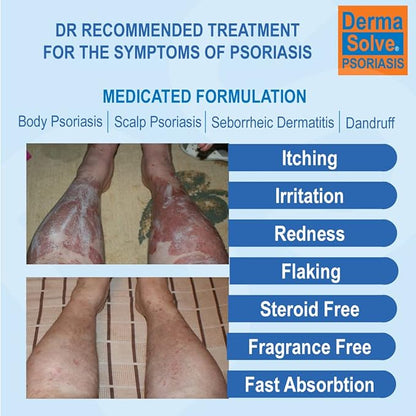 Extra Strength Psoriasis Cream (2 Pack) - Seborrheic Dermatitis & Dandruff Lotion - Advanced Moisturizing Relief Formulated to Treat Itchy Flakey Inflamed Skin and Prevent Future Flares - 4.0 oz ea.