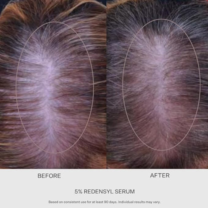 5% Redensyl Hair Growth Serum - Vegan Follicle Activator & Hair Thickening Serum for Men & Women's Hair Growth. Scalp & Hair Density Serum for Thicker, Fuller Hair Care