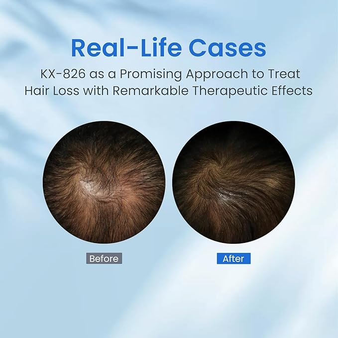 Hair Growth KX-826 DHT Blocker Hair Thickening,3 Days Oil Control 1-2 Weeks Hair Loss Reduction 4-6 Weeks Hair Regrowth Spray,Hair Loss Treatments -1 Month Supply 60ML (A-1 pack)