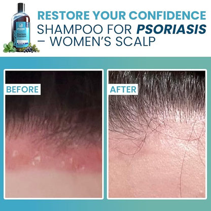 NEW 2025 Psoriasis Shampoo with Salicylic Acid | 13.5 fl. oz | New Formula with Peat and Menthol for itchy, flaky and red scalp.