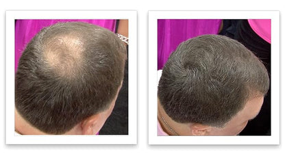 Caboki All-Natural Hair Building Fiber. Make Thin Hair Look 10X Fuller Instantly. Eliminate the Appearance of Bald Spot and Thinning Hair (30G, 90-Day Supply). Medium Brown