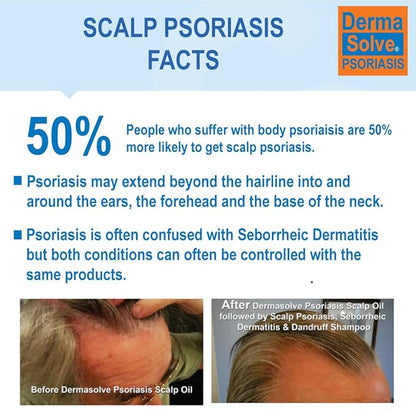 DermaSolve Scalp Psoriasis & Dandruff free Medicated Shampoo with Conditioner, Ultimate Seborrheic Dermatitis Treatment for Itchy, Flakey Scalp, Soothing & Moisturizing Relief