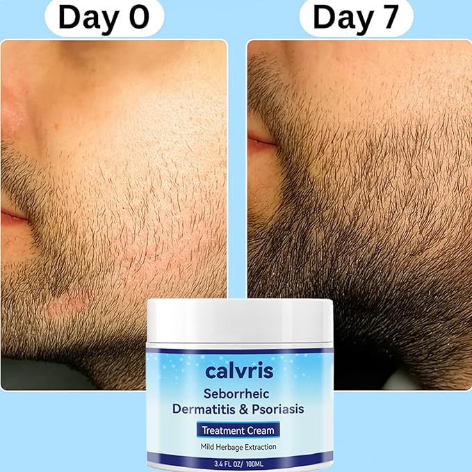 Calvris Scalp Comfort Balm - Steroid-Free Botanical Formula for Dry, Itchy Scalp & Skin, 3.4 Fl Oz | Natural Soothing Relief with Cooling Sensation