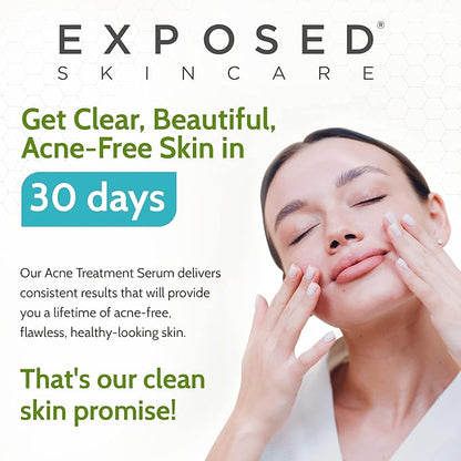 Exposed Skin Care, Acne Treatment Serum with 3.5% Benzoyl Peroxide – Lightweight Acne Spot Treatment – Quickly Clear Teen, Adult, Hormonal and Cystic Acne – Natural, Non-toxic and Cruelty Free