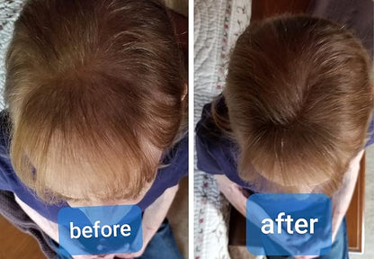 Caboki All-Natural Hair Building Fiber. Make Thin Hair Look 10X Fuller Instantly. Eliminate the Appearance of Bald Spot and Thinning Hair (30G, 90-Day Supply). Medium Brown