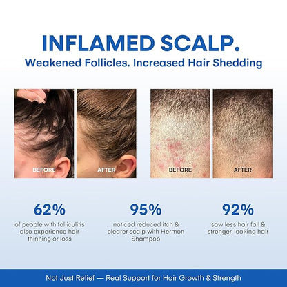 Hermon Folliculitis Shampoo for Itchy Scalp: Psoriasis, Dandruff & Seborrheic Dermatitis & Biotin – Soothes | Exfoliates | Reactivates Follicles