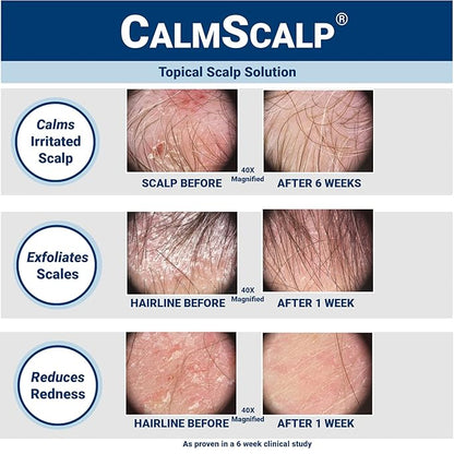 Scalp Serum | Scalp Itch Relief | Scalp Treatment | Exfoliates Scales and Flakes | Clinically Proven | Made in USA | 4 oz