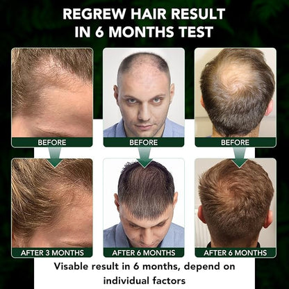 Minoxidil 5% for Men and Women Hair Growth Serum, Minoxidil Topical Solution Spray Treatment for Hair Loss, Thinning, Hair Regrowth & Thicker, Grow Hair Spray 2.02 fl.oz
