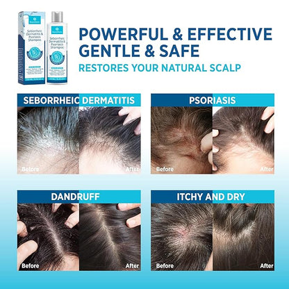 Roycederm Psoriasis Shampoo, Seborrheic Dermatitis Shampoo, Folliculitis, Dandruff, Scalp Psoriasis & Seborrheic Dermatitis Treatment, Dry Itchy Scalp Treatment - 2 Pack