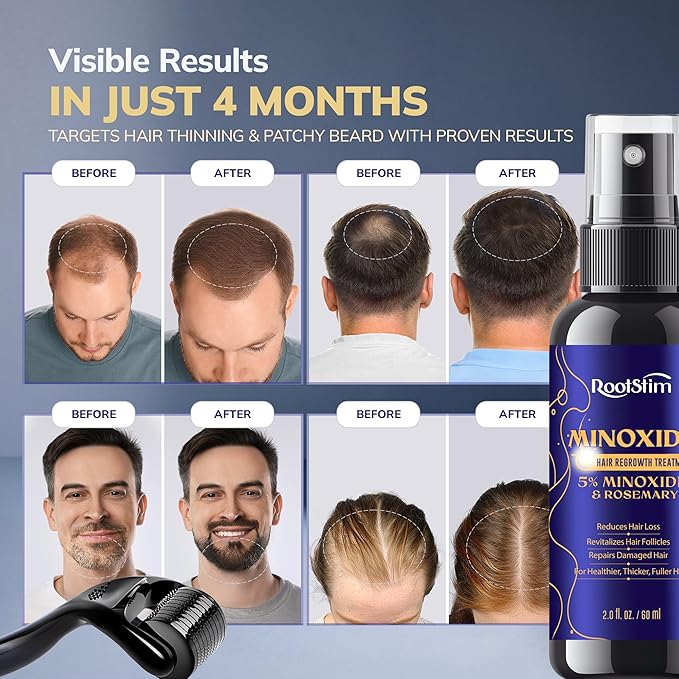 5% Minoxidil Kit for Men and Women with 0.25 mm Derma Roller – Beard Growth Kit & Hair Regrowth Spray – Targets Thinning Hairlines, Crowns & Patchy Beards – 60 mL