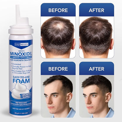 Men's Minoxidil Foam Hair-Regen Men’s 5% Minoxidil Foam 6-Month Supply for Hair Regrowth Minoxidil for Men